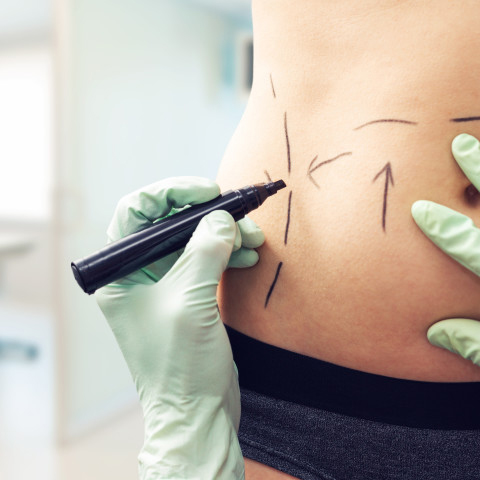 Coolsculpting Vs. Emsculpt