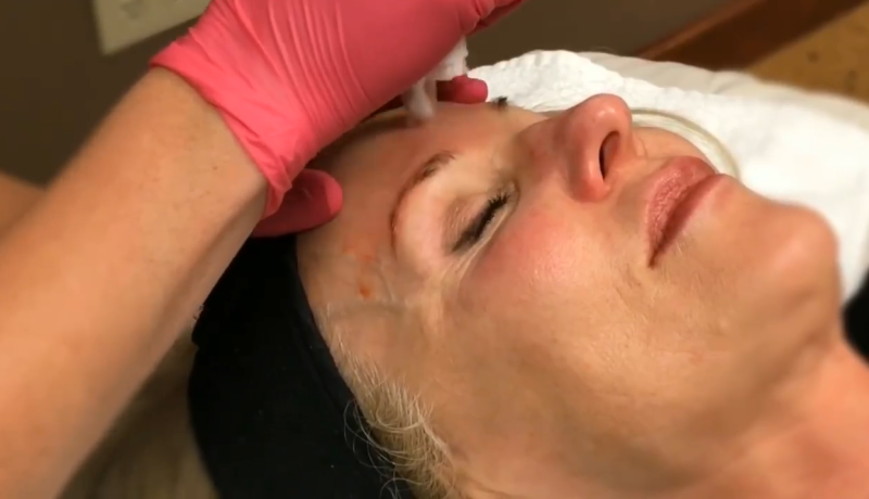 catalyst fargo vampire facial