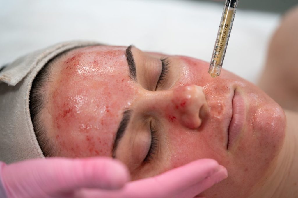 vampire facelift facial at rn esthetics l 1200x800