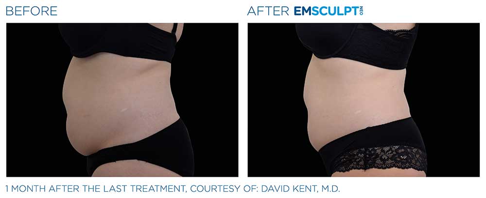 Emsculpt neo female abdomen