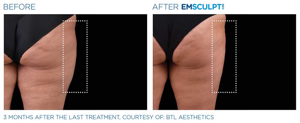 Emsculpt neo female outer thighs