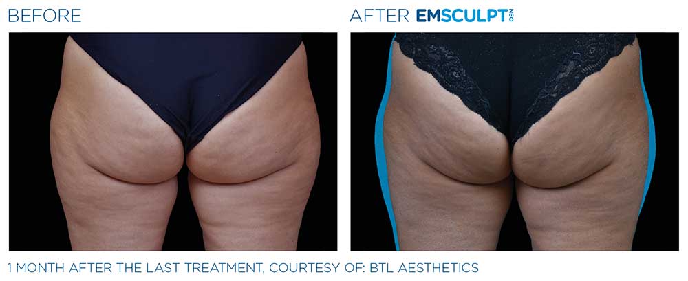 Emsculpt neo female outer thighs