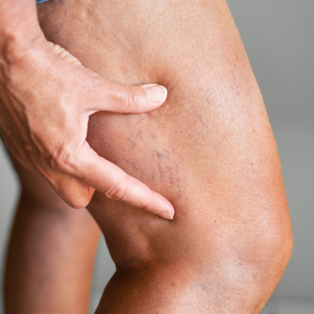 vein screening at catalyst