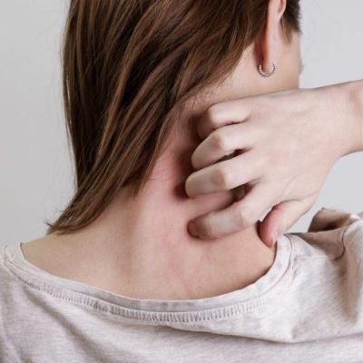 Catalyst-Dermatology-Eczema-Treatment